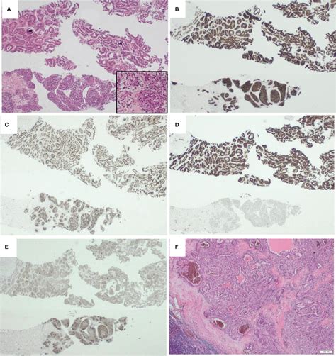 Morphological Appearances Of Kat A Nrg Fusion Renal Cell Carcinoma