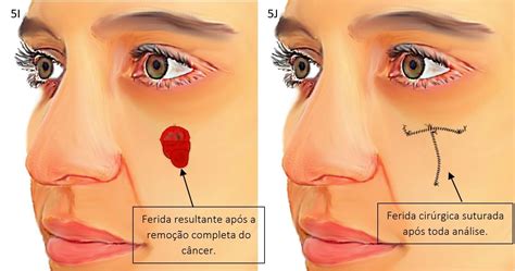 O Que é Carcinoma Espinocelular