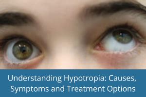 Hypertropia: Causes, Symptoms, Diagnosis and Treatment