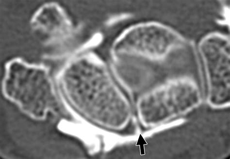 Multidetector Ct Arthrography Of The Wrist Joint How To Do It