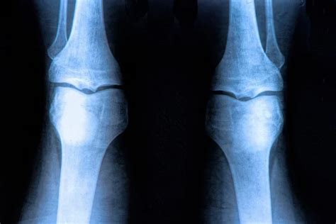 Acl Tear Surgery & Reconstruction-Recovery and Regeneration: ACL Tear ...