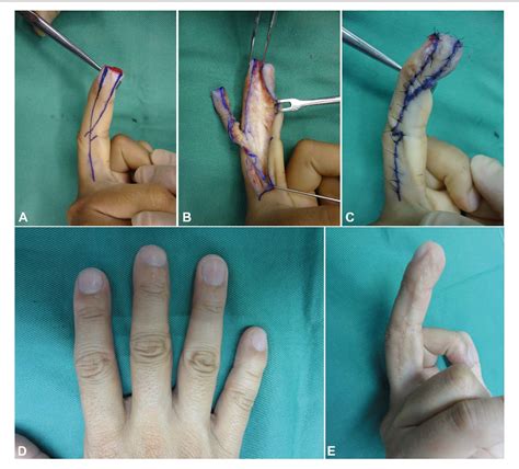 Figure 2 From Hirase Triangular Neurovascular Advancement Flap And The Reverse Digital Artery