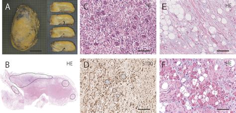 Macroscopic And Microscopic Findings A Macroscopic Appearance Of The