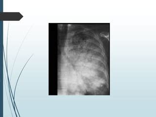 Rx De T Rax Pdf Interpretaci N De Radiograf A De T Rax Ppt