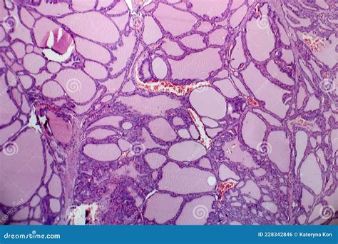 Histopathology Of Endemic Goitre Stock Photo Image Of Detail