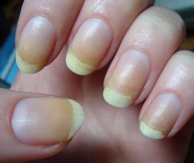 Get Rid Of Yellow Or Discolored Nails With These Natural Remedies ...