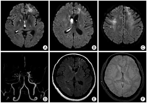 Magnetic Resonance MR Imaging Obtained On Admission Diffusion