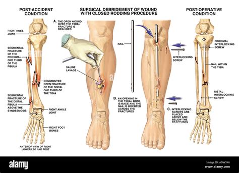 Fractured Tibia And Fibula Broken Lower Leg Bones With Fixation Stock