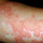 Liver Disease Rash Pictures Photos