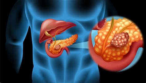 Causa De Cancer Pancreas - Câncer de Pâncreas - Meu Guia Oncologia