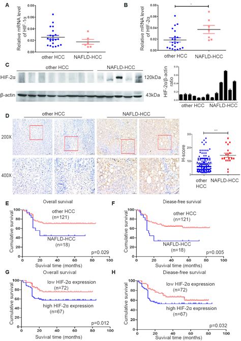 HIF 2α upregulation mediated by hypoxia promotes NAFLD HCC progression