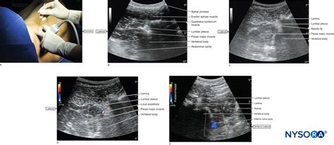 Sonography Of The Lumbar Paravertebral Space And Considerations For The