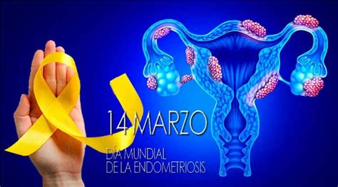 Noticiero Panorama Queretano 14 de marzo Día Mundial de la Endometriosis