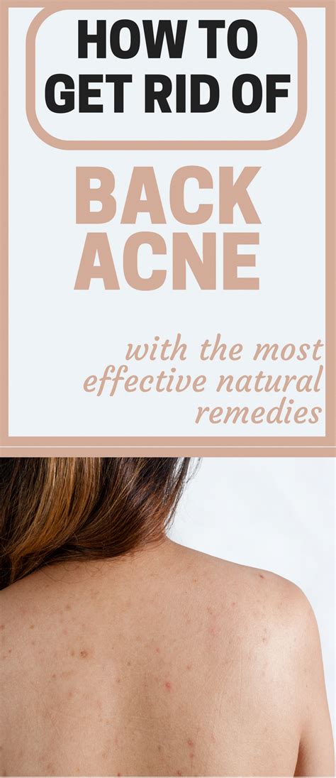 How To Get Rid Of Back Acne With The Most Effective Natural Remedies Acnetips Acne Remedies