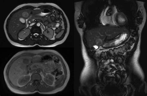 The Magnetic Resonance Imaging Mri Examination Of The Upper Abdomen Download Scientific