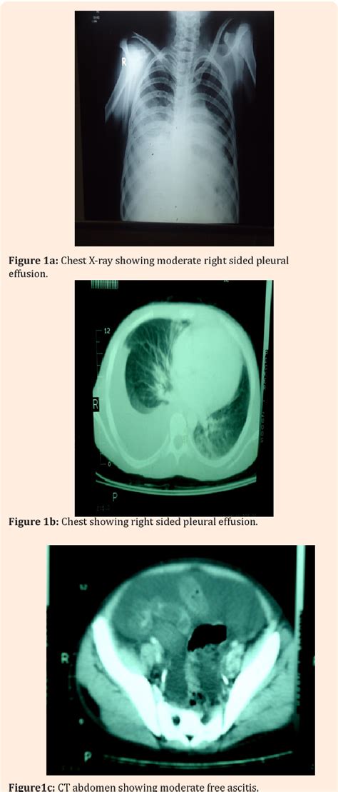 Figure 1 From Castlemans Disease As A Rare Differential Diagnosis Of