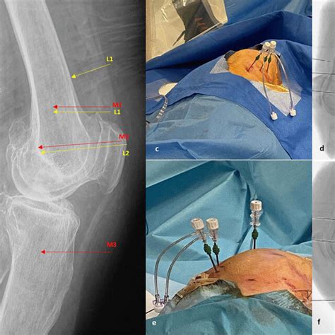 A B Anteroposterior And Lateral Radiographs Of An Arthritic Knee Download Scientific Diagram