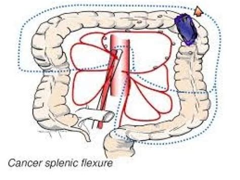 Laparoscopic Extended Left Hemicolectomy Unedited Video Youtube