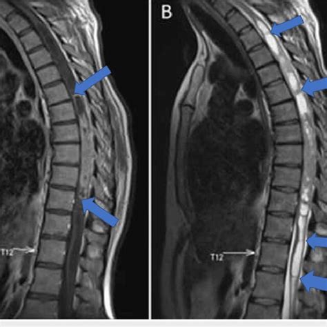 Postoperative Mri Of The Thoracic Spine Showing Complete Removal Of The