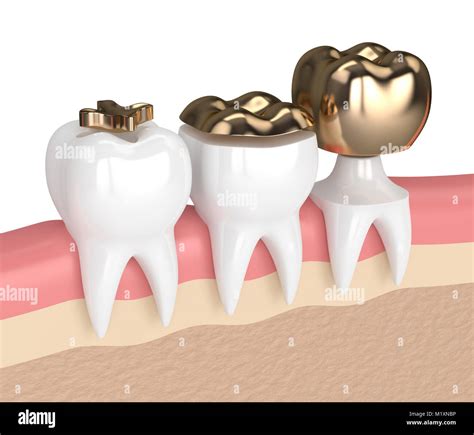 D Render Of Teeth With Inlay Onlay And Crown Gold Filling In Gums