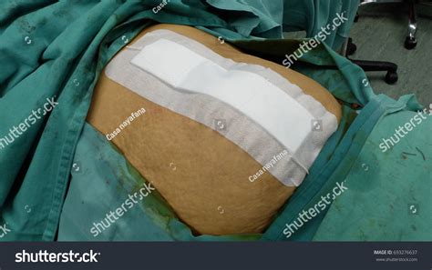 Abdominal Wound Closure Stapler Dressing Step Stock Photo 693276637 | Shutterstock