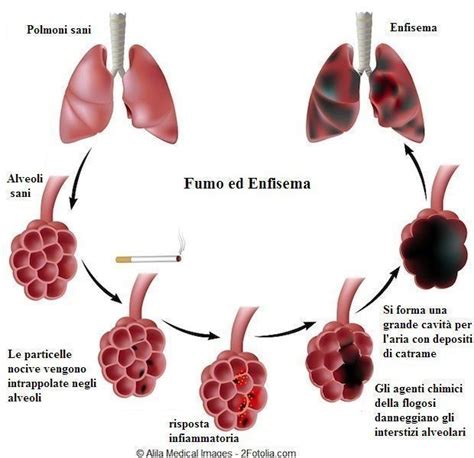 Enfisema Polmonare Sintomi Intervento E Prognosi