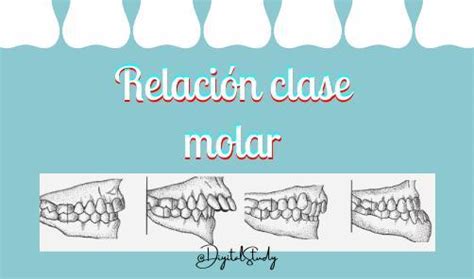 Relacion clase molar Relación clase molar Maloclusiones uDocz