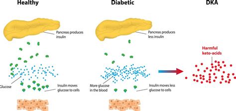 Diabetic Ketoacidosis (DKA) definition, symptoms, diagnosis, treatement