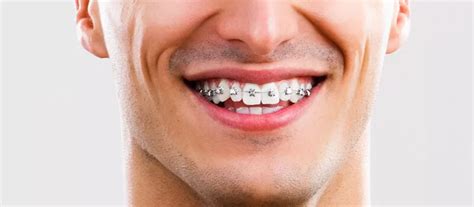 Meilleur Orthodontiste Casablanca Abdelmoumen Dr Abbassi