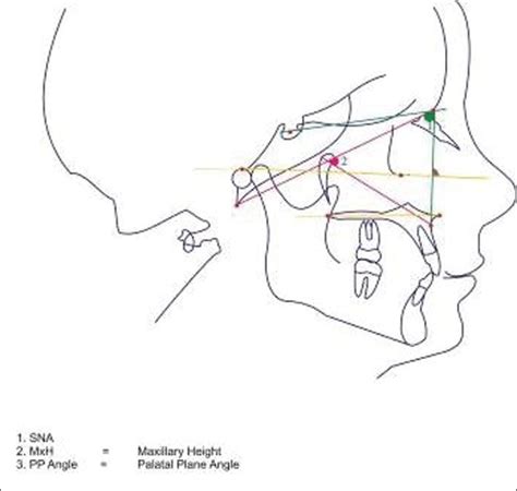 Angular Measurements Of The Maxilla Download Scientific Diagram