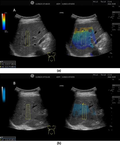 Ultrasound Based Hepatic Fat Quantification Current Status And Future