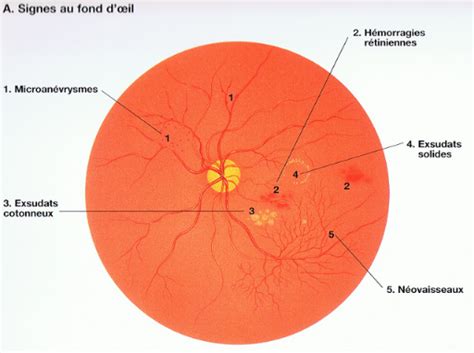 Partager 47 Images A Quoi Sert Un Fond D Oeil Fr Thptnganamst Edu Vn