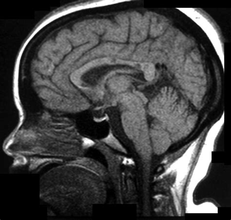 Mri Of Susac S Syndrome Ajr