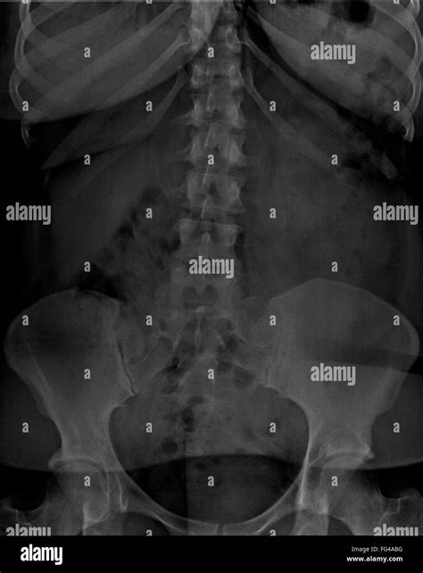 Labeled Abdominal X Ray