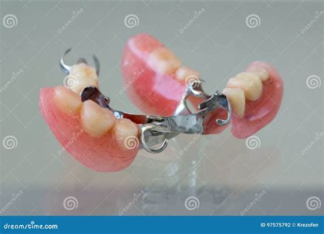 Clasp Denture with a Metal Arc Stock Photo - Image of care, denture ...