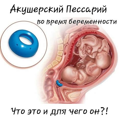 Акушерский пессарий. Ответы на вопросы,которые тревожат будущих мам. - etel