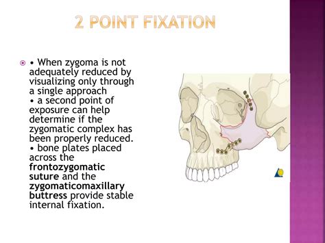 Zygomatic Complex Fracture Ppt