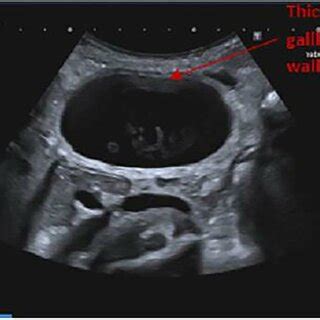 Ultrasound abdomen showing a thickened gallbladder wall. | Download ...