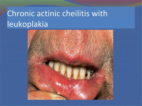 Cheilitis Ppt