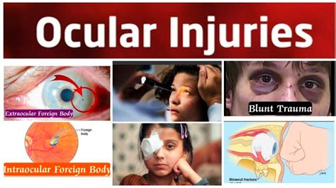 Ocular Injury 4 Major Intraocular Foreign Bodies Siderosis Bulbi Chalcosis And Penetrating