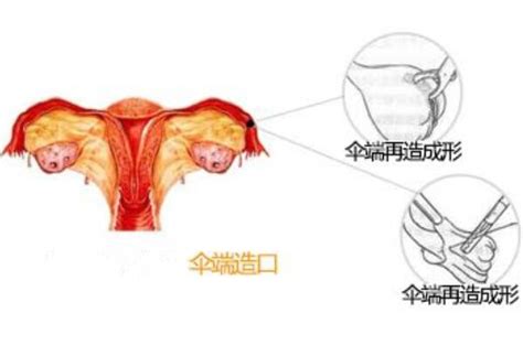 赴美试管前，输卵管积水患者该如何为好孕加分？ 梦美生命