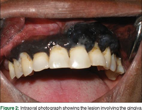 Figure 1 From Intraoral Malignant Melanoma Semantic Scholar