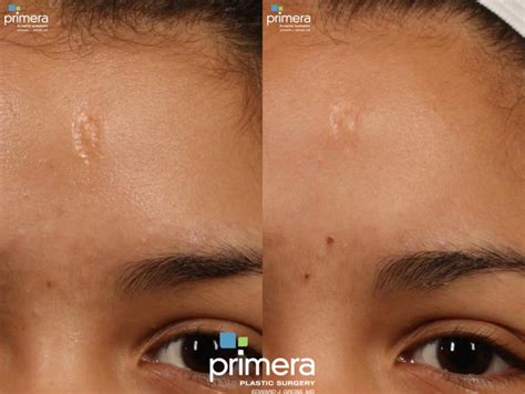 Acne Scarring Laser Treatment Before And After