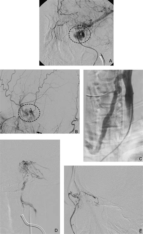 Coiling Of A Carotid Cavernous Sinus Fistula Via Microsurgical Venotomy Recommendation Of A