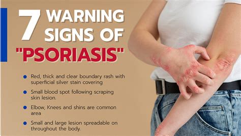 There Are Seven Signs That You Have Psoriasis Phitsanulok Hospital