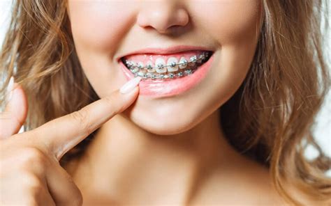 What To Expect Affordable Braces Invisalign In Melbourne