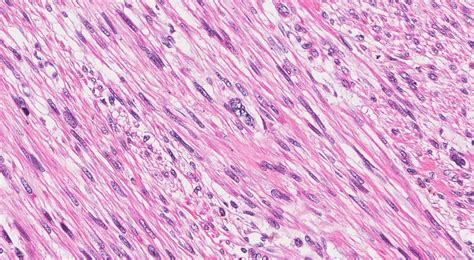 Leiomyosarcoma of the skin | Ottawa Atlas of Pathology