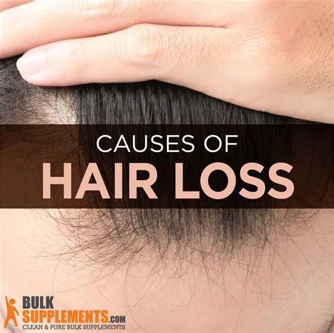 Hair Loss Characteristics Causes And Treatment