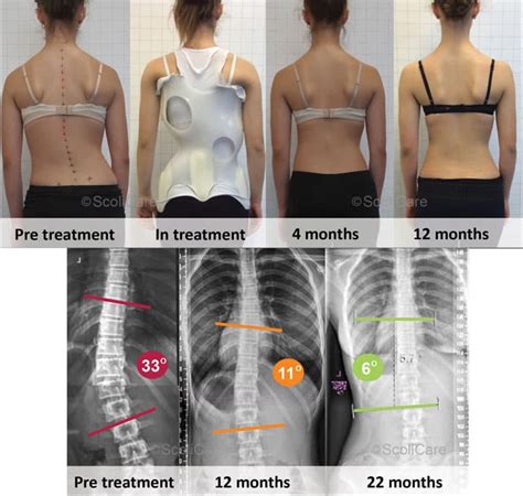 Scoliosis Brace Before And After