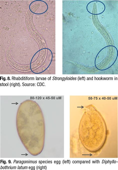 Parasites in tissue: how to identify the structures | CAP TODAY